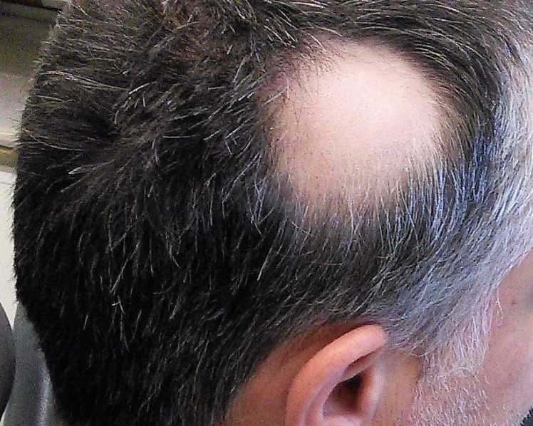 effective-scalp-micropigmentation-for-alopecia-skulltec
