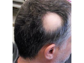 effective-scalp-micropigmentation-for-alopecia-skulltec-small-0