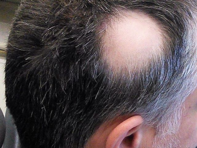 effective-scalp-micropigmentation-for-alopecia-skulltec