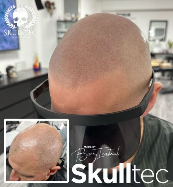 premium-hair-pigmentation-services-in-london-skulltec-big-0