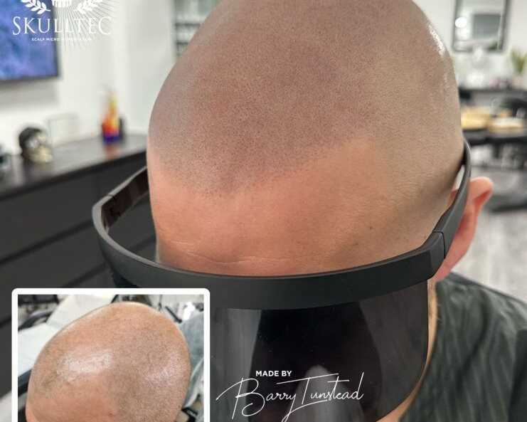 premium-hair-pigmentation-services-in-london-skulltec