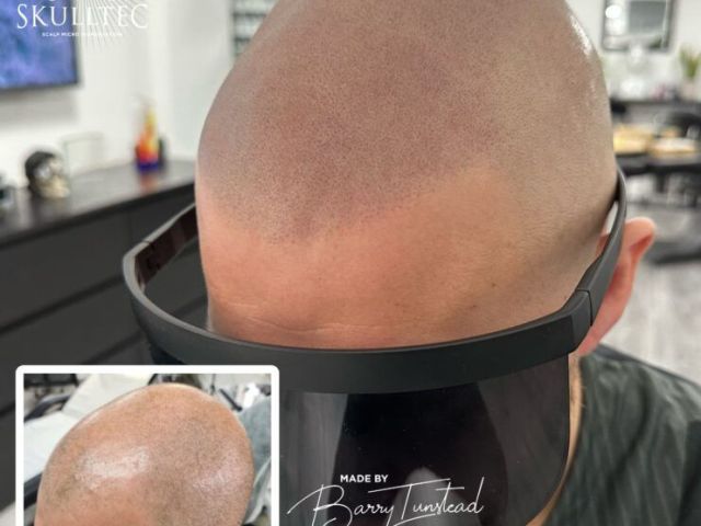 premium-hair-pigmentation-services-in-london-skulltec