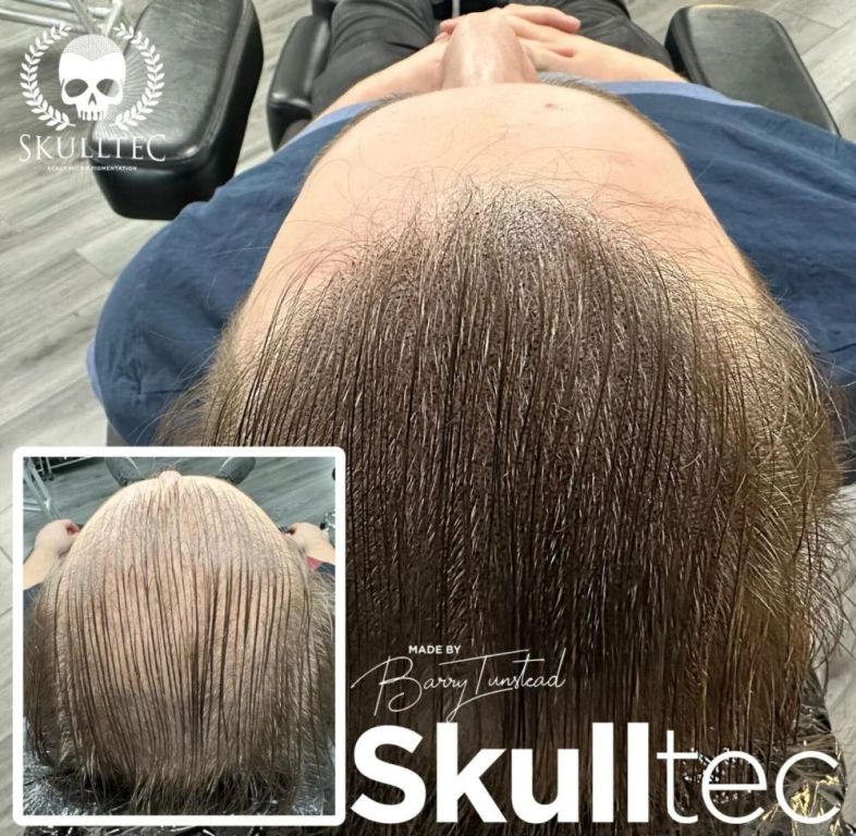 effective-hair-loss-solutions-for-men-in-scotland-skulltec-big-0