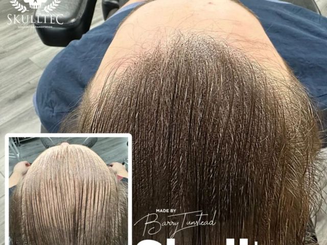 effective-hair-loss-solutions-for-men-in-scotland-skulltec
