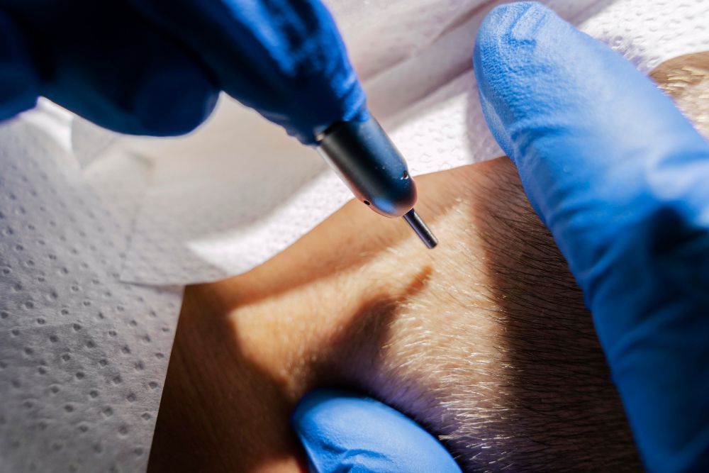 the-best-uk-hair-transplant-clinic-in-london-leeds-manchester-big-1