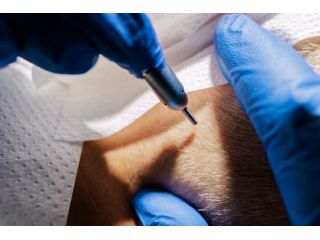 the-best-uk-hair-transplant-clinic-in-london-leeds-manchester-small-1
