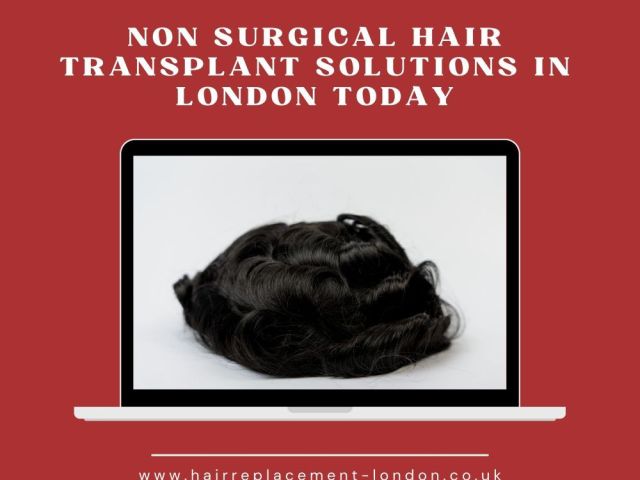 non-surgical-hair-transplant-solutions-in-london-today