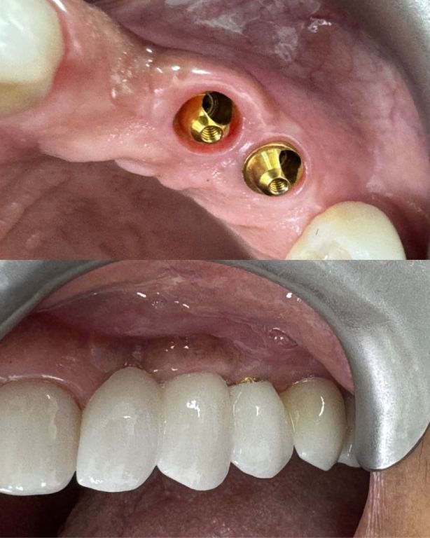 dental-implant-solutions-at-marlow-dental-centre-big-0