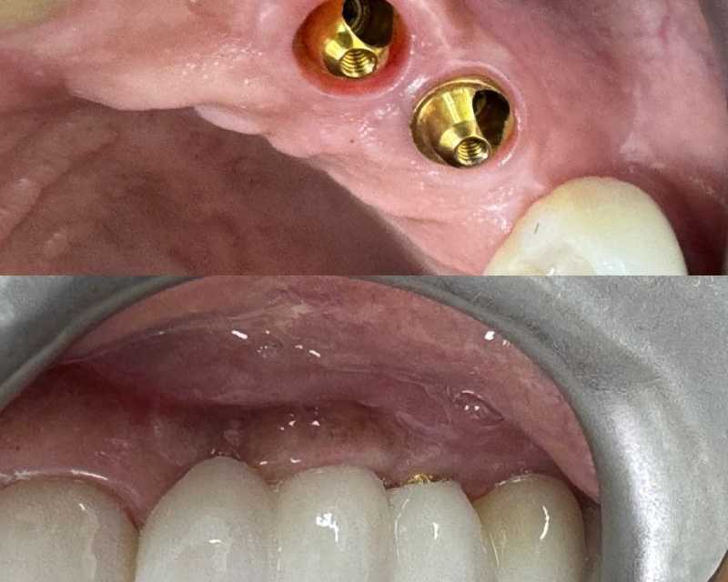 dental-implant-solutions-at-marlow-dental-centre