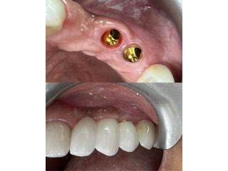 dental-implant-solutions-at-marlow-dental-centre-small-0