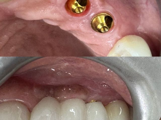 dental-implant-solutions-at-marlow-dental-centre