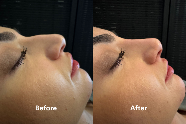 looking-for-non-surgical-rhinoplasty-in-chiswick-book-now-big-1