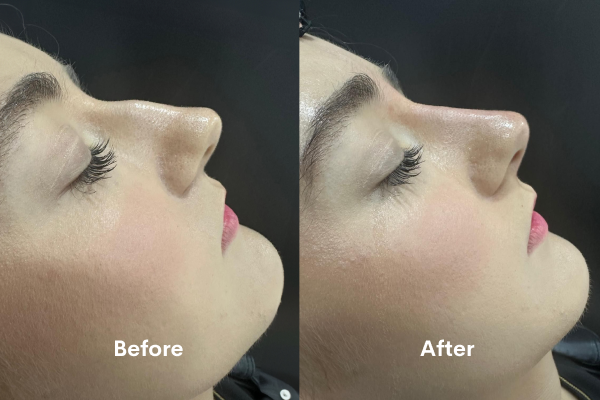 looking-for-non-surgical-rhinoplasty-in-chiswick-book-now-big-0