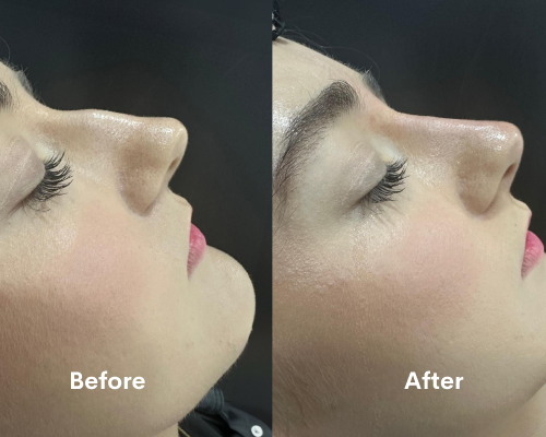 looking-for-non-surgical-rhinoplasty-in-chiswick-book-now