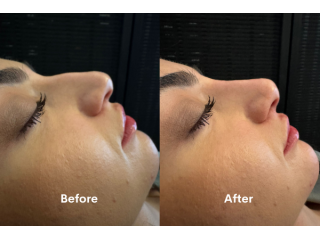 looking-for-non-surgical-rhinoplasty-in-chiswick-book-now-small-1