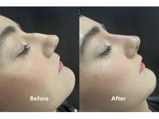 looking-for-non-surgical-rhinoplasty-in-chiswick-book-now-small-0
