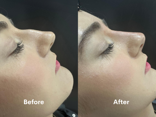 looking-for-non-surgical-rhinoplasty-in-chiswick-book-now