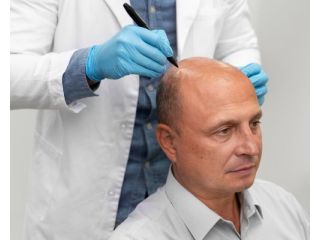 advanced-hair-replacement-services-for-men-in-london-small-0