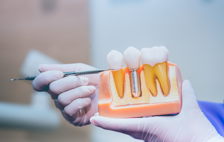free-implant-consultation-essex-love-implants-big-0
