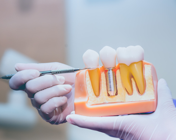 free-implant-consultation-essex-love-implants