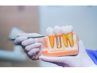 free-implant-consultation-essex-love-implants-small-0