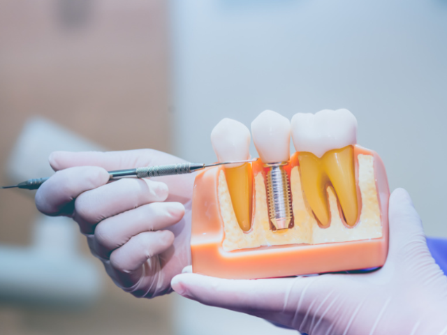 free-implant-consultation-essex-love-implants
