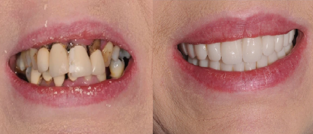 full-mouth-implant-consultation-colchester-love-implants-big-0