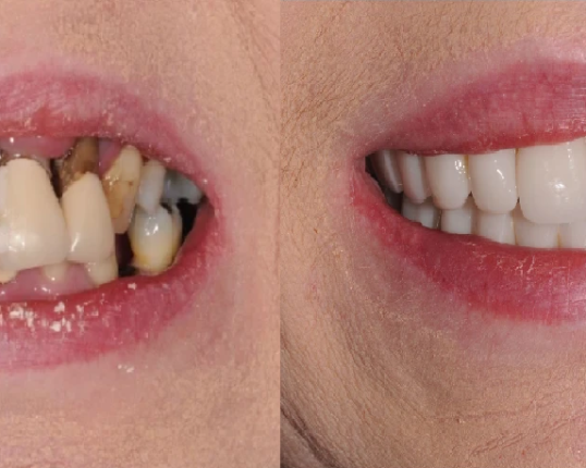 full-mouth-implant-consultation-colchester-love-implants