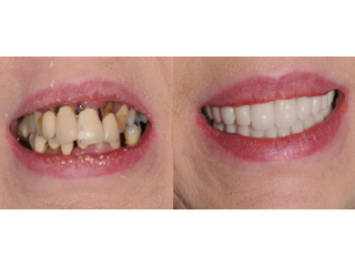 full-mouth-implant-consultation-colchester-love-implants-small-0