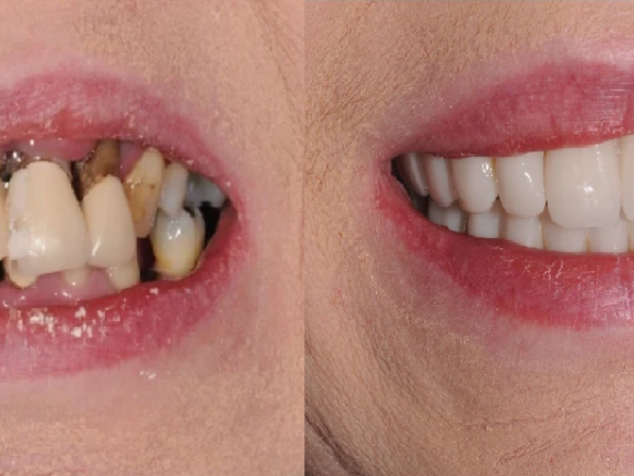 full-mouth-implant-consultation-colchester-love-implants