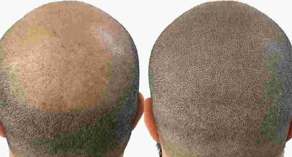 professional-hair-pigmentation-big-0