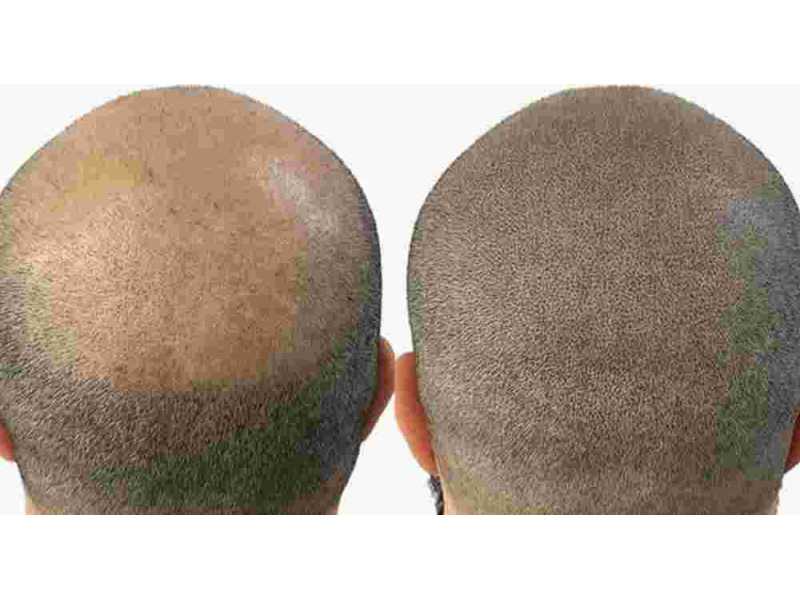 professional-hair-pigmentation-small-0