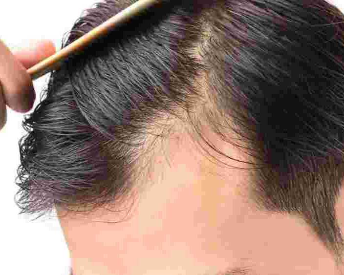 effective-hair-loss-solutions-for-men-in-glasgow-skulltec