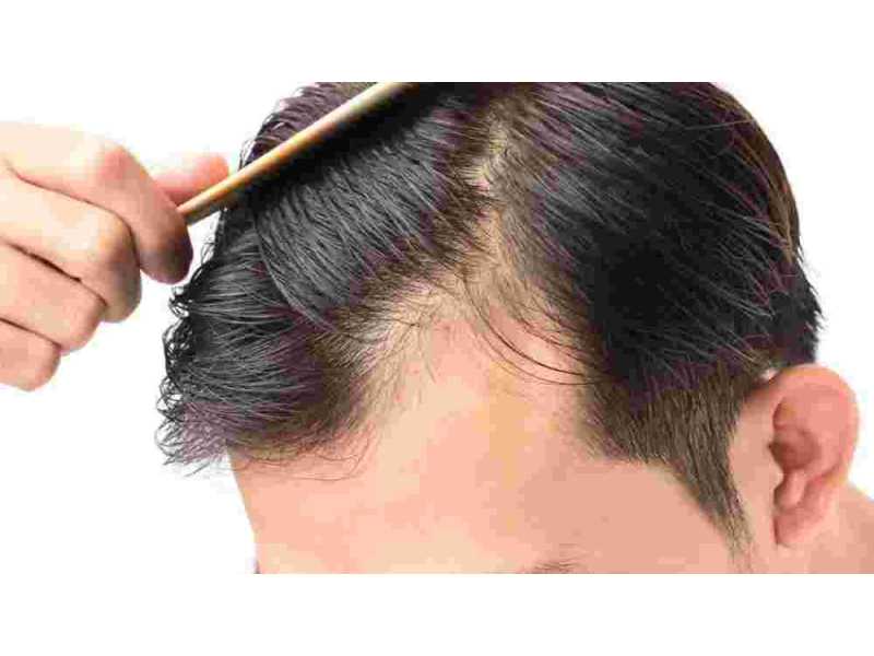 effective-hair-loss-solutions-for-men-in-glasgow-skulltec-small-0