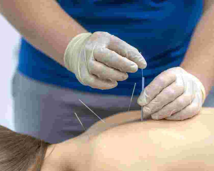 central-london-acupuncture-for-natural-pain-relief
