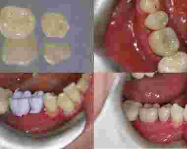 same-day-cerec-crowns-in-marlow-for-fast-tooth-restoration