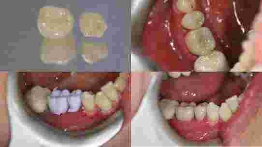 same-day-cerec-crowns-in-marlow-for-fast-tooth-restoration-big-0