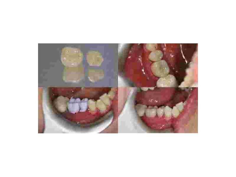 same-day-cerec-crowns-in-marlow-for-fast-tooth-restoration-small-0