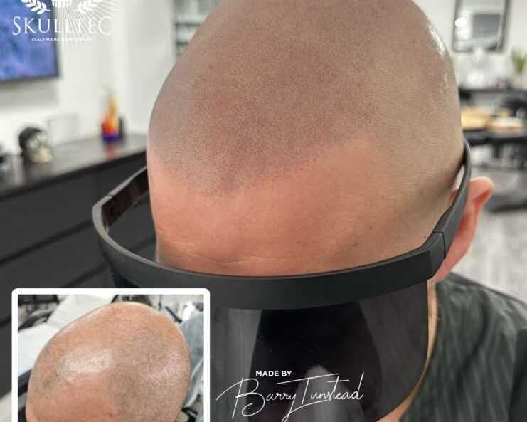 effective-hair-loss-solutions-for-men-in-glasgow-skulltec
