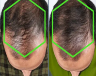 best-mens-hair-loss-treatment-in-barking
