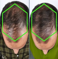 best-mens-hair-loss-treatment-in-barking-big-0