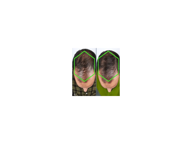 best-mens-hair-loss-treatment-in-barking-small-0