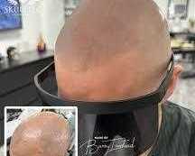 best-scalp-micropigmentation-in-london-skulltec