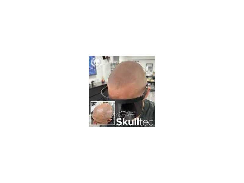 best-scalp-micropigmentation-in-london-skulltec-small-0