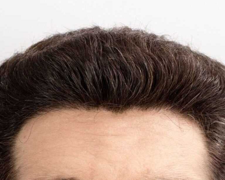 expert-smp-for-hairline-restoration-skulltec