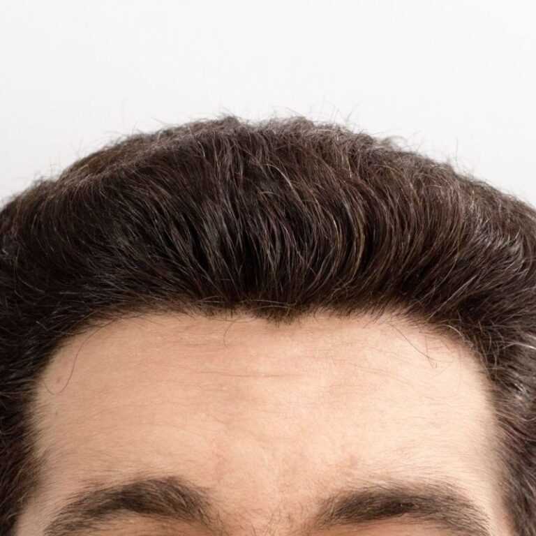 expert-smp-for-hairline-restoration-skulltec-big-0