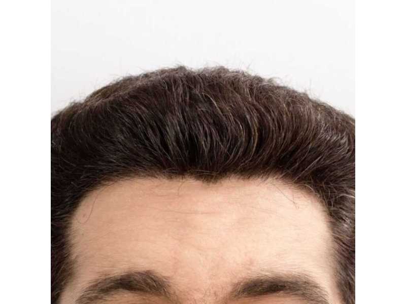 expert-smp-for-hairline-restoration-skulltec-small-0