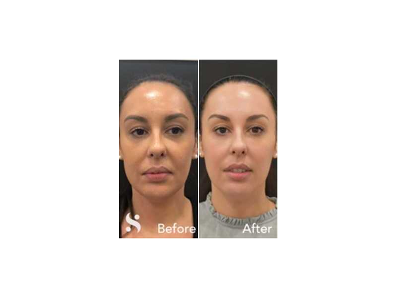 skin-clinic-leeds-expert-aesthetic-treatments-for-radiant-skin-small-0