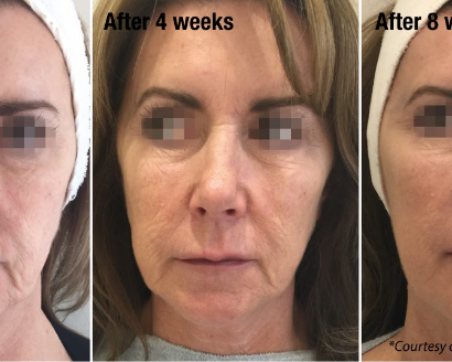 profhilo-leeds-advanced-skin-rejuvenation-treatment