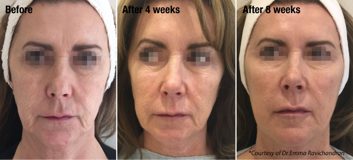 profhilo-leeds-advanced-skin-rejuvenation-treatment-big-0
